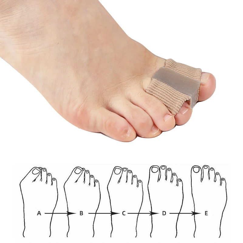New Toe Separator Hallux Valgu - Toe Separator Silicon recensie en prijs